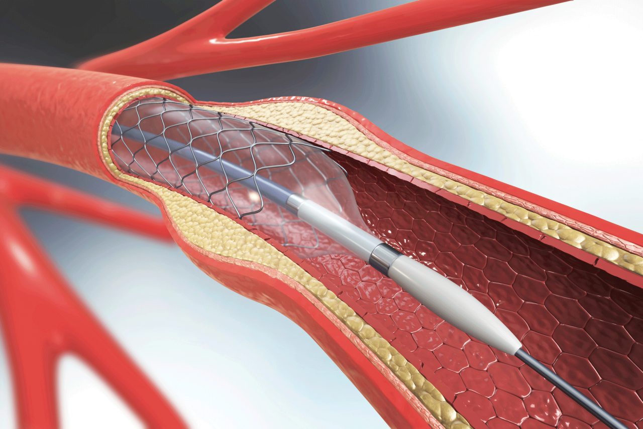 Coronary Artery Stent