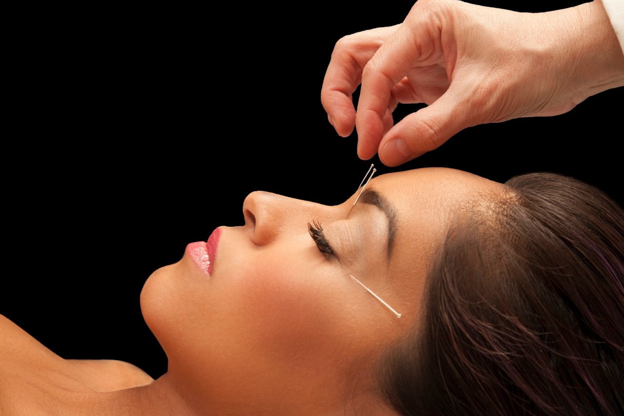 Young woman getting acupuncture treatment for health and beauty --- Image by © Becky Yee/Corbis