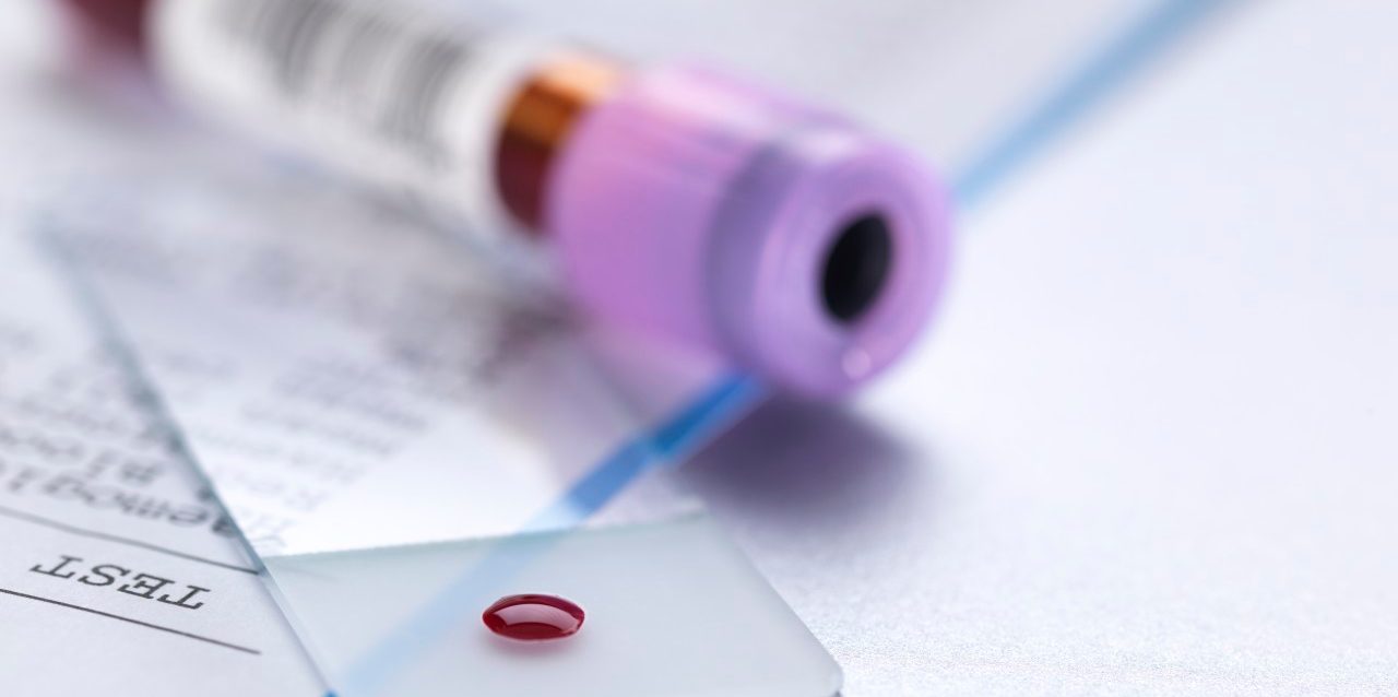 Blood sample on microscope slide with vial and results of the blood test. --- Image by © Andrew Brookes/Corbis