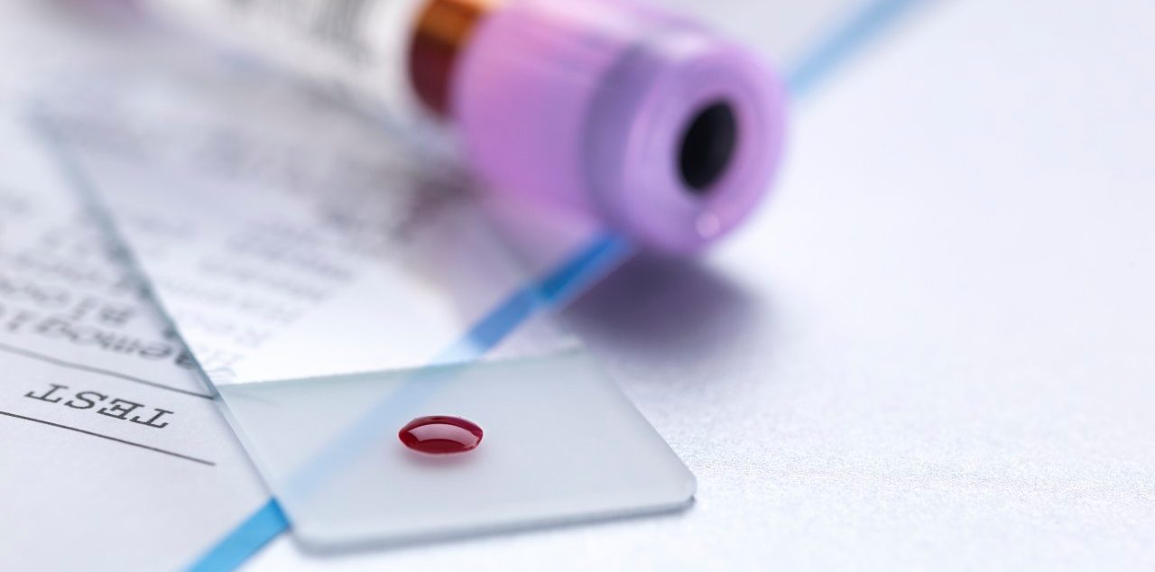 Blood sample on microscope slide with vial and results of the blood test. --- Image by © Andrew Brookes/Corbis