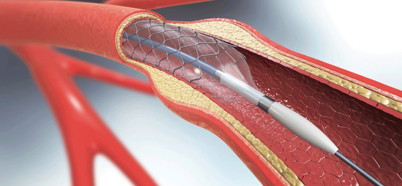 Coronary Artery Stent