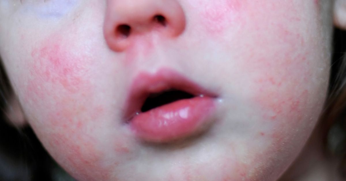 The characteristic strawberry bumps are caused by bacteria, which can spread throughout your body. So don’t ignore scarlet fever rash