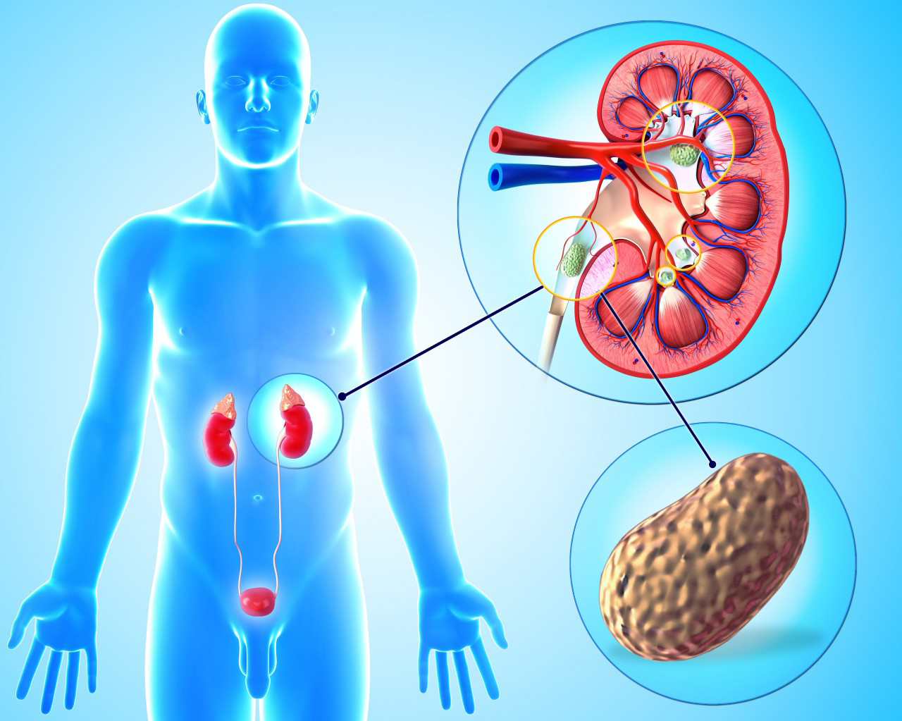 23 Jan 2013 --- Kidney stone. --- Image by © SHUBHANGI GANESHRAO KENE/Science Photo Library/Corbis