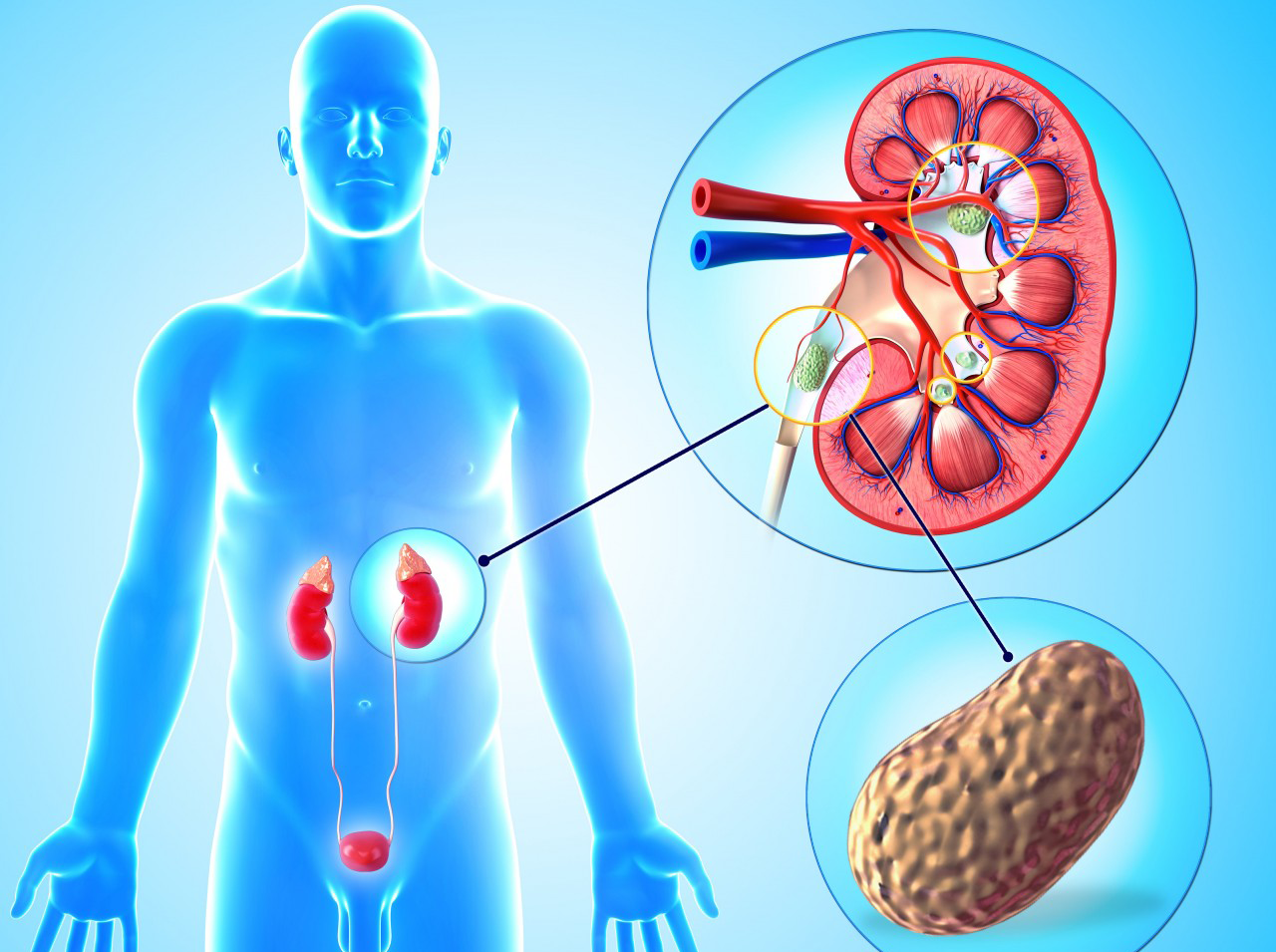 23 Jan 2013 --- Kidney stone. --- Image by © SHUBHANGI GANESHRAO KENE/Science Photo Library/Corbis