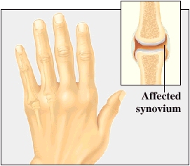 What is Rheumatoid Arthritis?