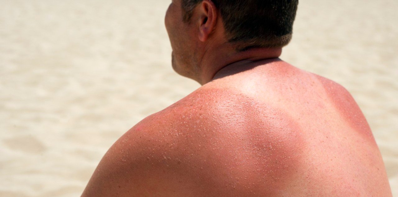 Sunburn --- Image by © IAN HOOTON/Science Photo Library/Corbis