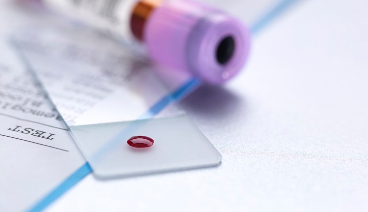 Blood sample on microscope slide with vial and results of the blood test. --- Image by © Andrew Brookes/Corbis