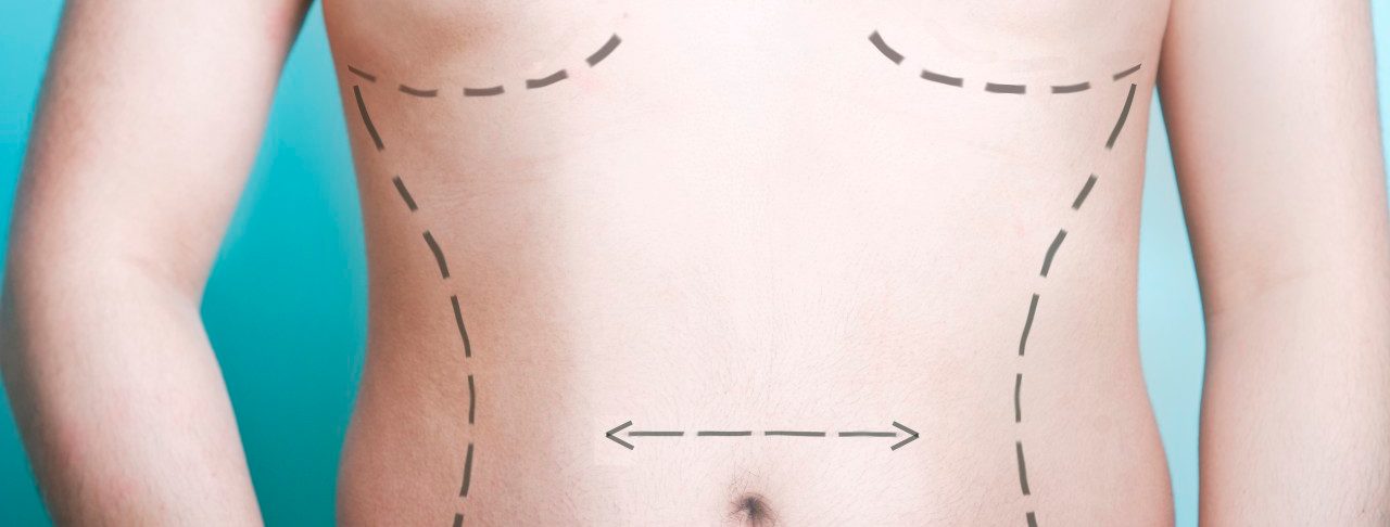 Close-up view of man's body with plastic surgery line markings --- Image by © Jana Lohde/moodboard/Corbis