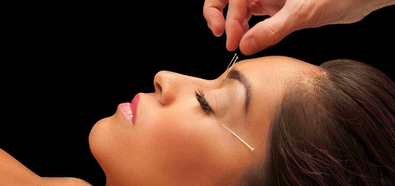 Young woman getting acupuncture treatment for health and beauty --- Image by © Becky Yee/Corbis