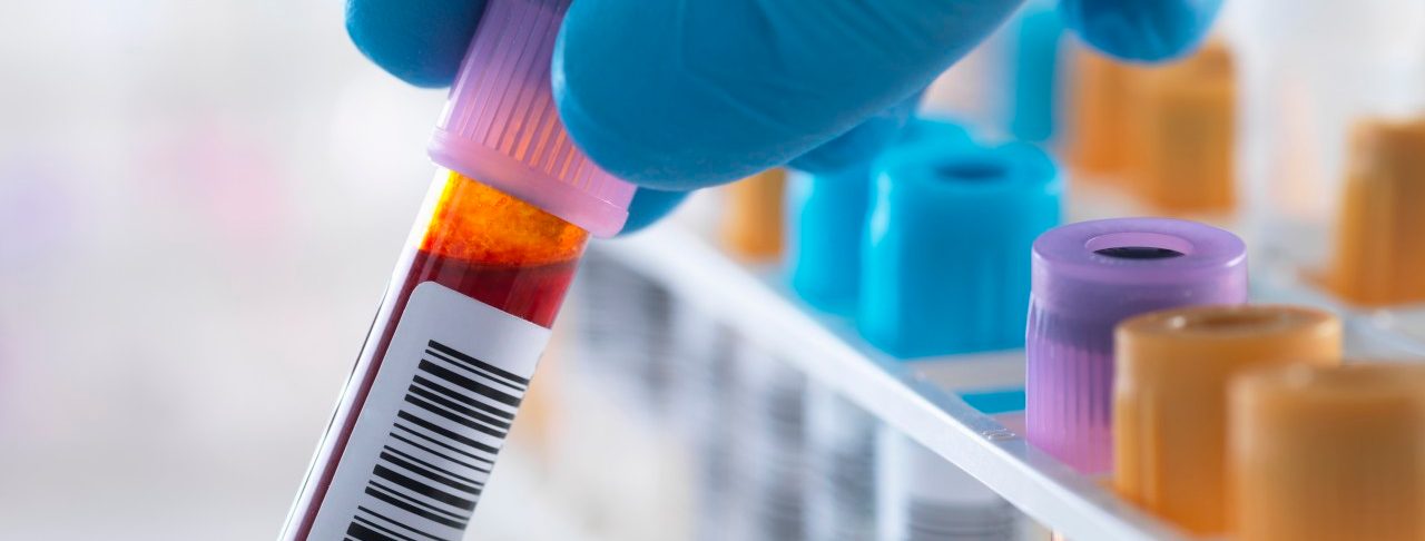 23 Jan 2014 --- A blood sample being held with a row of human samples for analytical testing including blood, urine, chemistry, proteins, anticoagulants and HIV in lab --- Image by © Rafe Swan/Corbis